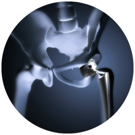 Hip Replacement