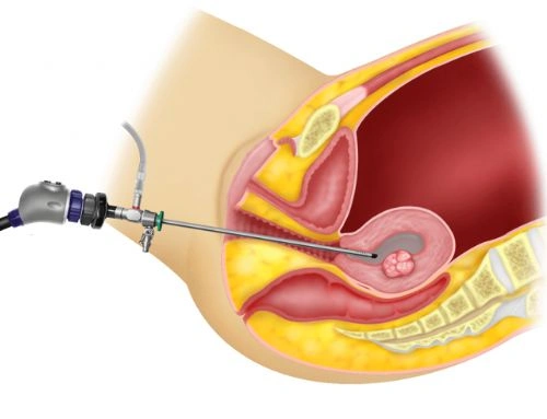 Hysteroscopy surgery