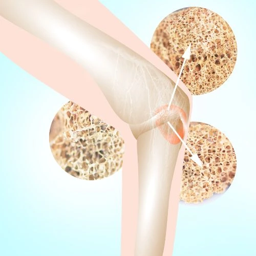 Osteoporosis treatment