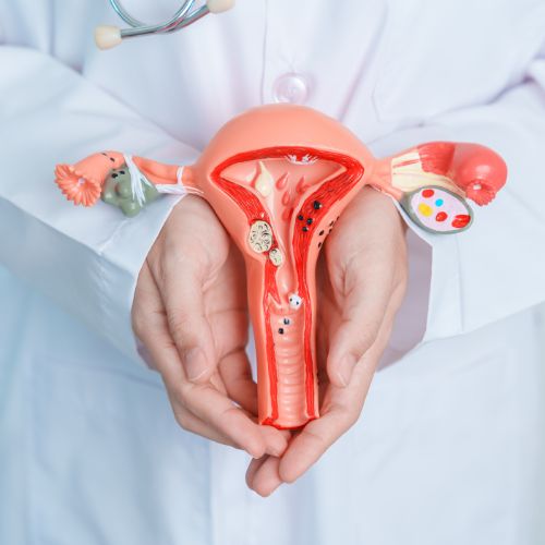 UTERINE FIBROIDS