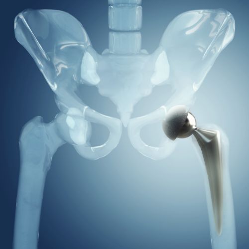 advance hip replacement surgry