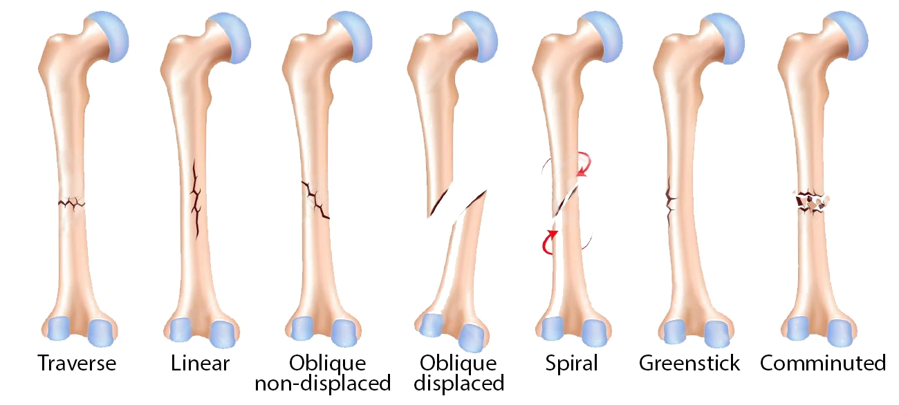 types of fractures